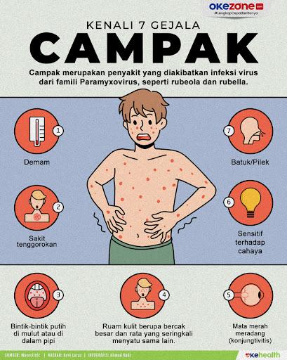 Meningkatnya Kasus Campak di Indonesia di awal Tahun 2026