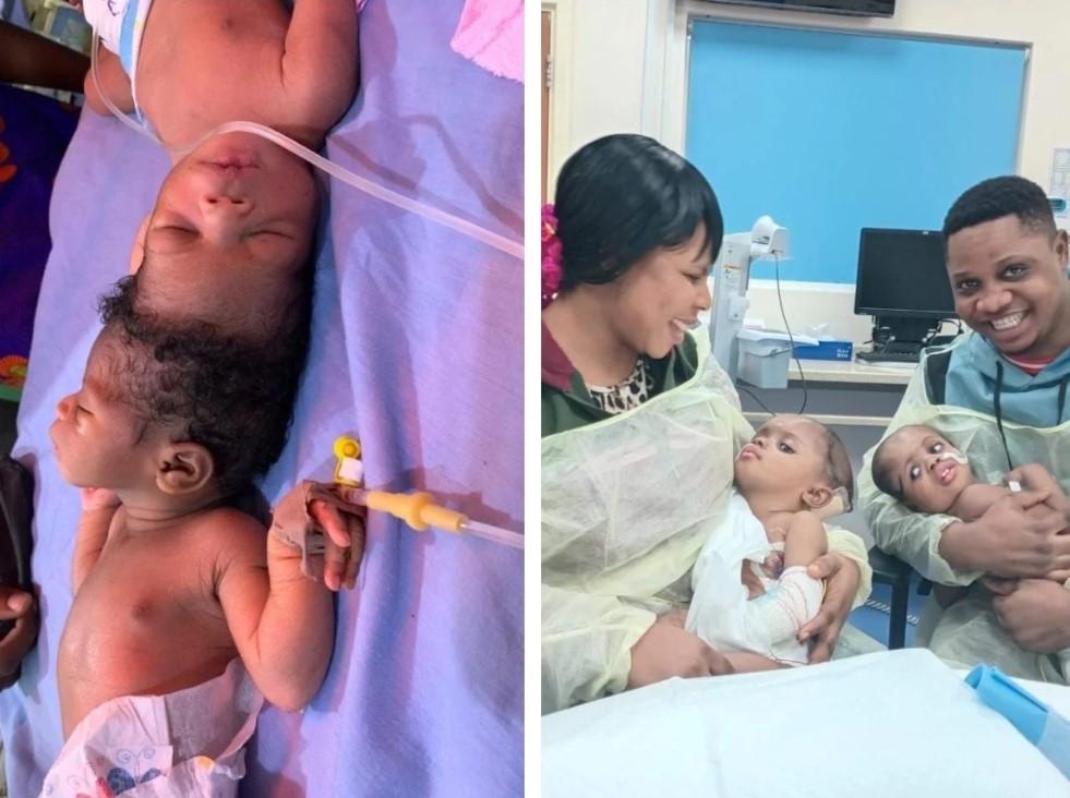 Kembar Siam Nigeria Menyatu di Kepala Berhasil Dipisahkan dengan Bantuan AI
